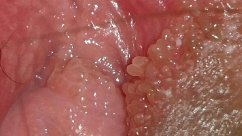 Gai sinh dục nữ xuất hiện khi nào? Những điều cần biết về gai sinh dục