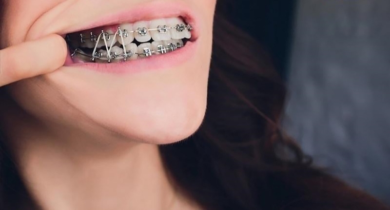 Gắn band niềng răng có đau không? Khi nào cần gắn band niềng răng 1