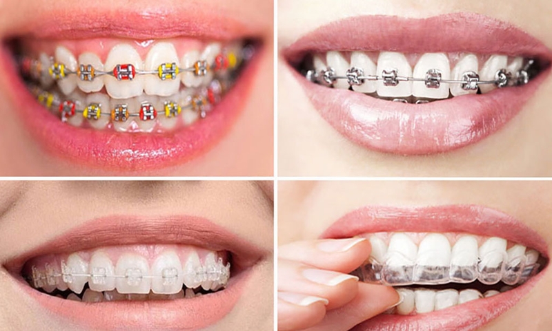 Gắn band niềng răng có đau không? Khi nào cần gắn band niềng răng 3