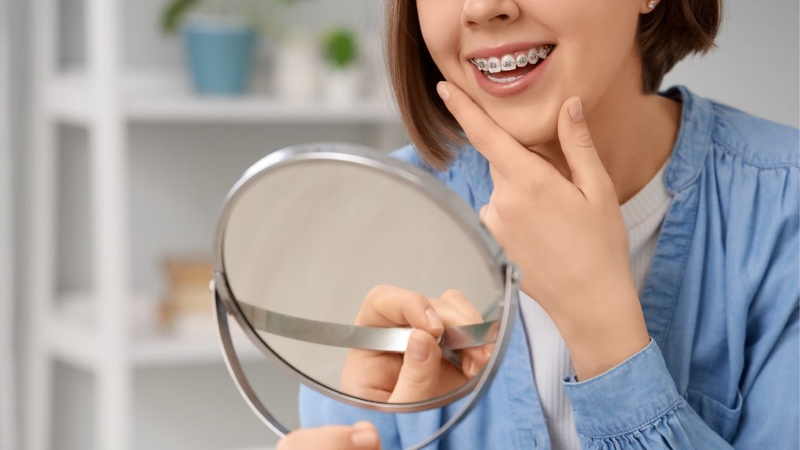 Gắn mắc cài là bước quan trọng trong quá trình niềng răng