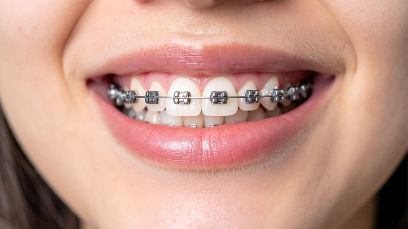 Cảm giác ê nhẹ sau khi gắn mắc cài là phản ứng bình thường