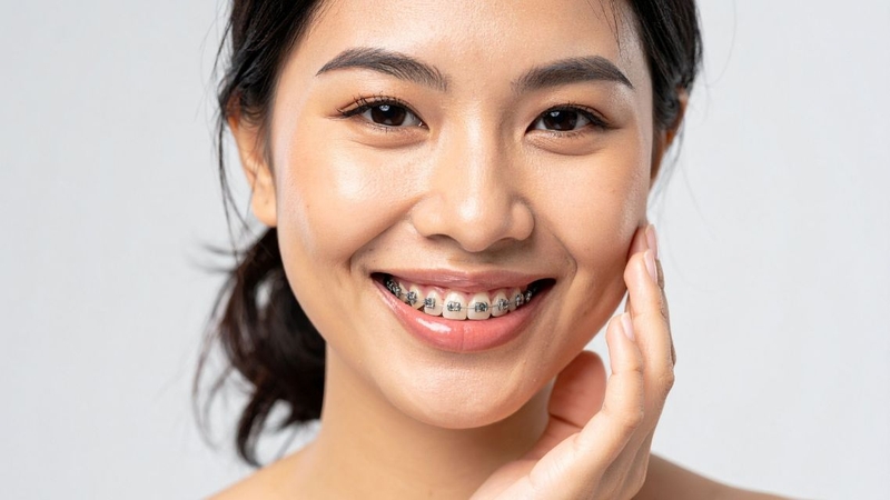 Quy trình gắn mắc cài được thực hiện cẩn thận, đảm bảo an toàn