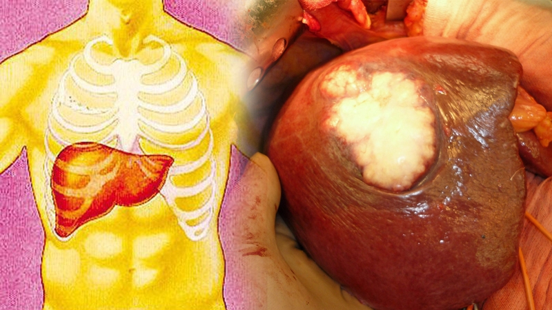 Gan nhiễm mỡ có nguy hiểm không? 5 biến chứng của bệnh gan nhiễm mỡ ai cũng cần biết 1