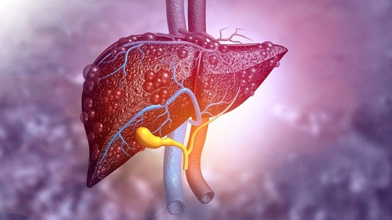 Gan nhiễm mỡ có nguy hiểm không? 5 biến chứng của bệnh gan nhiễm mỡ ai cũng cần biết 7