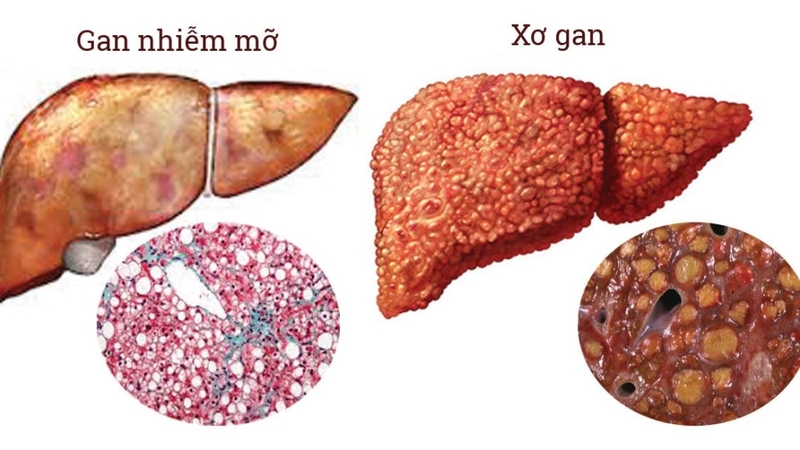 Gan nhiễm mỡ độ 1 có chữa khỏi không? Khám phá cách quản lý bệnh hiệu quả 4