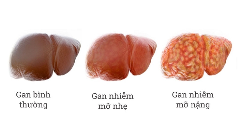 Gan nhiễm mỡ độ 1 có nguy hiểm không? Bị gan nhiễm mỡ độ 1 nên ăn gì? 1