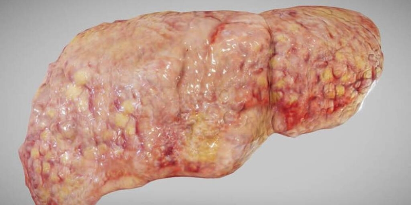 Gan nhiễm mỡ độ mấy là nặng? Điều trị bệnh gan nhiễm mỡ như thế nào? 1