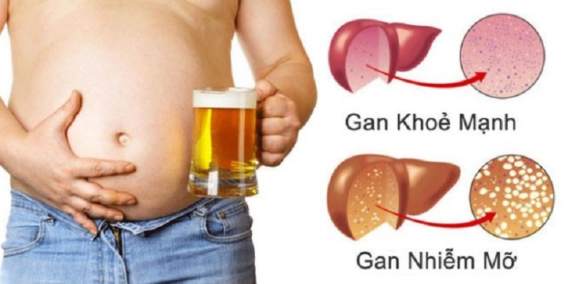 Gan nhiễm mỡ do nghiện rượu bia2
