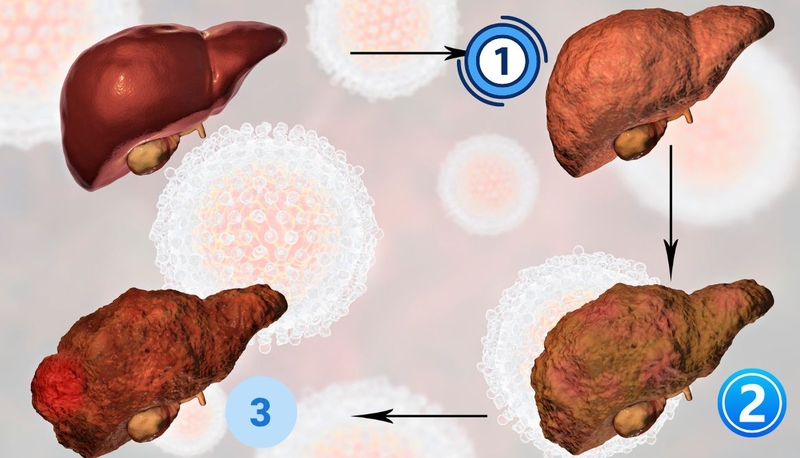 Thế nào là gan nhiễm mỡ trung bình? Nguyên nhân, triệu chứng, cách điều trị 1