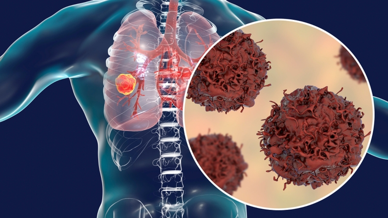 Gánh nặng ung thư toàn cầu trong bối cảnh hiện nay và dự kiến trong tương lai 2