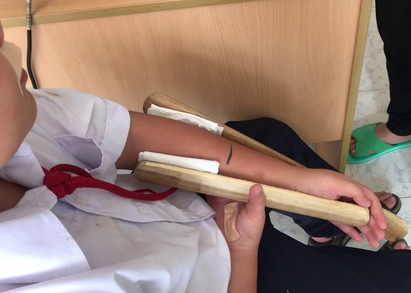 Giải đáp: khi gặp người bị tai nạn gãy xương phải làm gì? 3