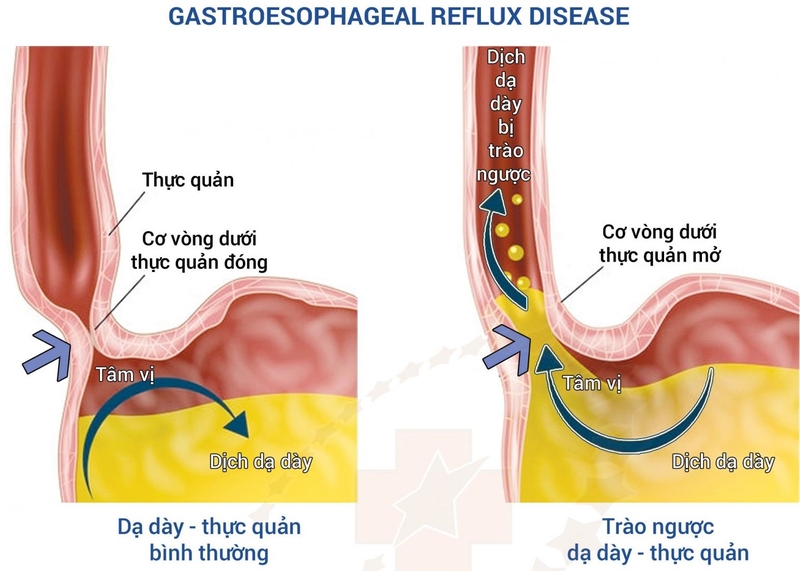 Gaviscon có dùng được cho bà bầu không? Những lưu ý khi sử dụng thuốc Gaviscon 1