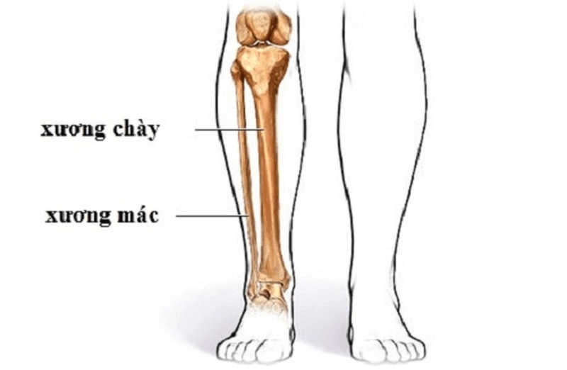 Gãy 1/3 dưới xương mác có nguy hiểm không? 1