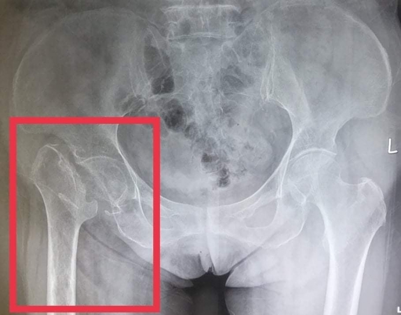 Gãy cổ xương đùi là gì