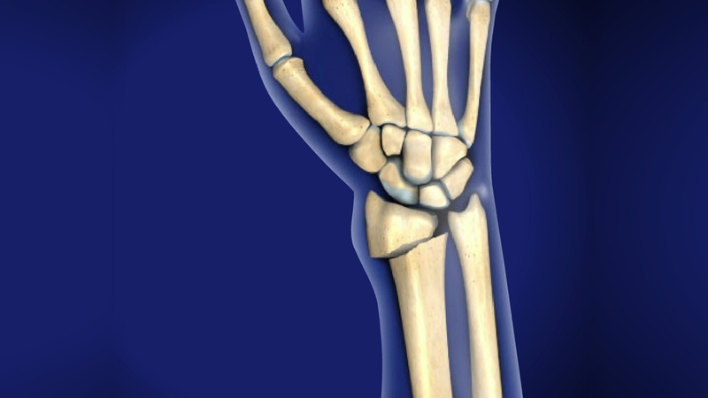 Gãy đầu dưới xương quay: Dấu hiệu, chẩn đoán, cách điều trị và giai đoạn hồi phục 1