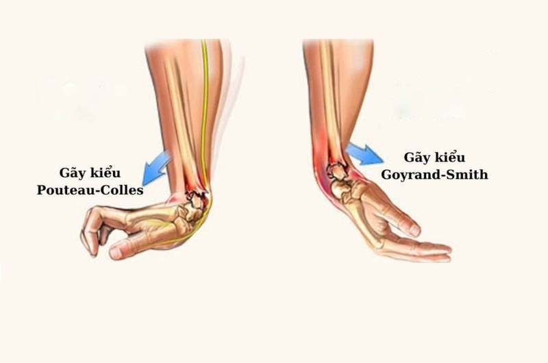 Gãy goyrand smith là gì? Nguyên nhân, triệu chứng, cách điều trị 1