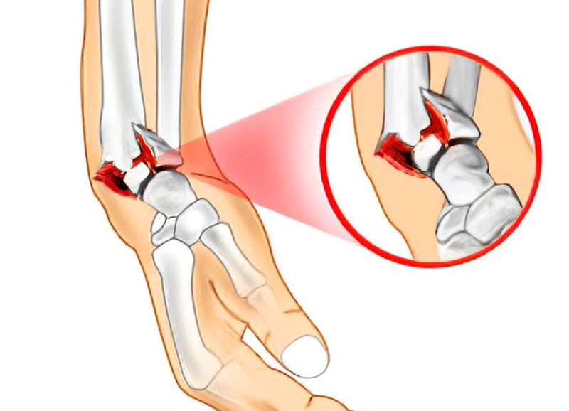 Gãy goyrand smith là gì? Nguyên nhân, triệu chứng, cách điều trị 2