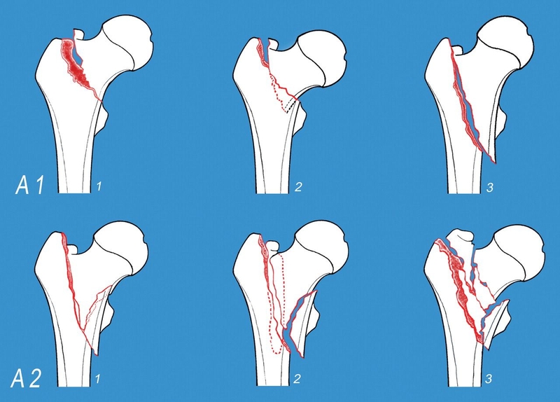 Tổng quan về tình trạng gãy liên mấu chuyển xương đùi 4