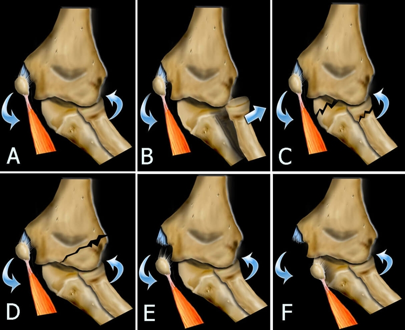Gãy lồi cầu ngoài xương cánh tay điều trị như thế nào 1