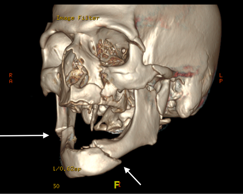 Gãy lồi cầu xương hàm dưới và những điều bạn nên biết&nbsp;2
