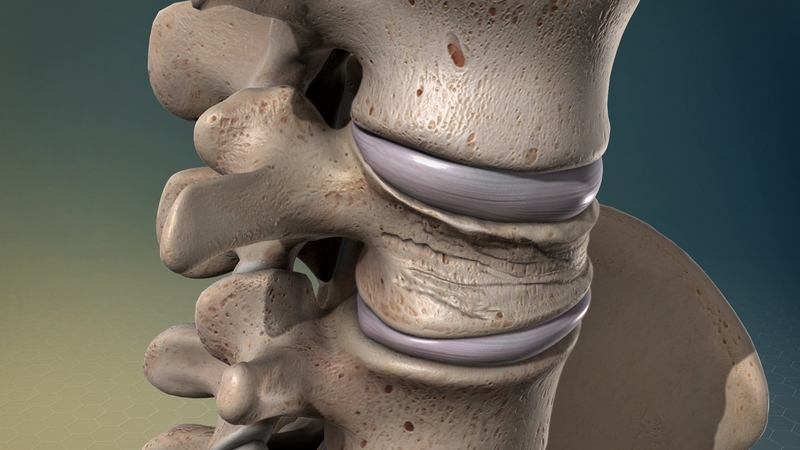 Gãy nén đốt sống là gì? Nguyên nhân và chẩn đoán điều trị