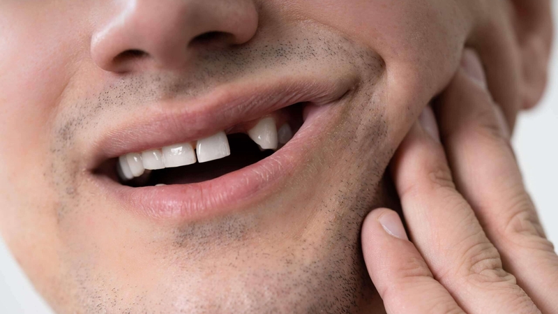 Gãy răng gây ra những ảnh hưởng nào với sức khỏe 1