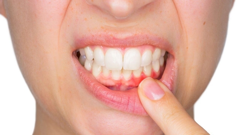 Gãy răng gây ra những ảnh hưởng nào với sức khỏe 2