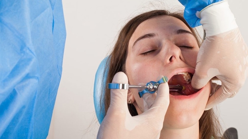 Gây tê hay gây mê khi nhổ răng khôn và những lưu ý sau khi nhổ răng 1