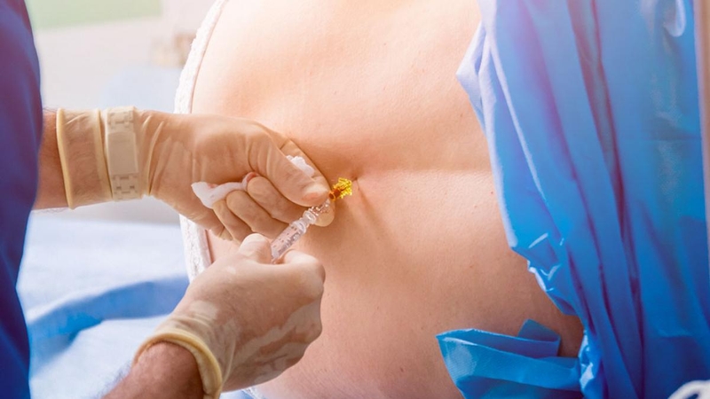 Gây tê màng cứng có ảnh hưởng đến sức khỏe không 2