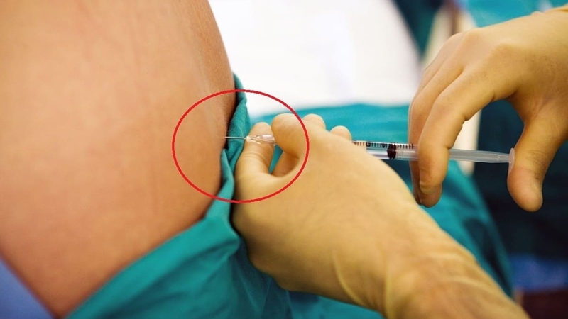 Gây tê ngoài màng cứng có đau không? Lợi ích và tác dụng phụ 2