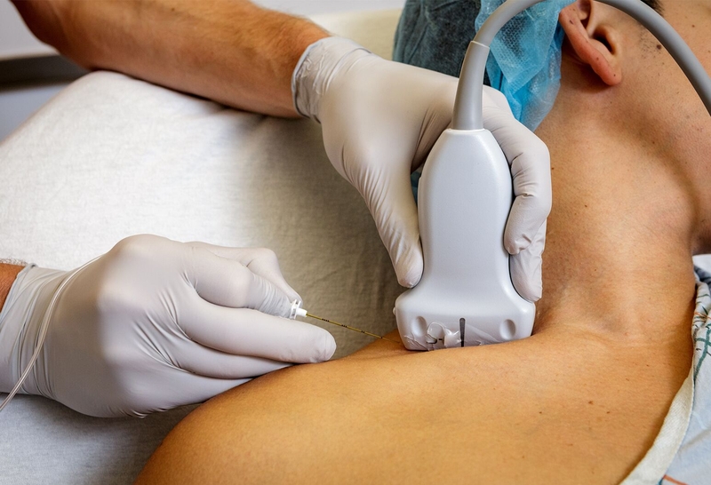 Gây tê vùng phong bế thần kinh ngoại vi những thông tin cần biết 2