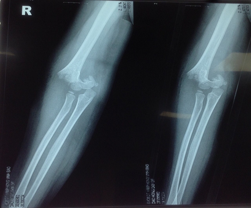 Gãy trên lồi cầu xương cánh tay là gì Triệu chứng và chẩn đoán 1