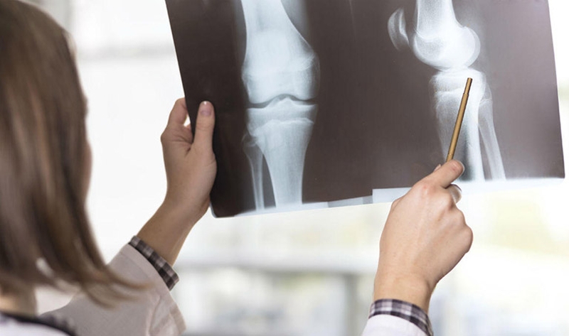 gãy xương bánh chè 4