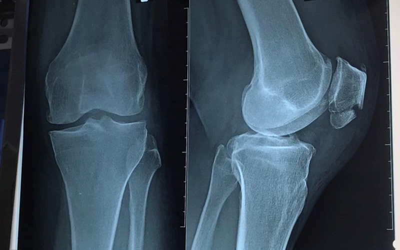 gãy xương bánh chè 1