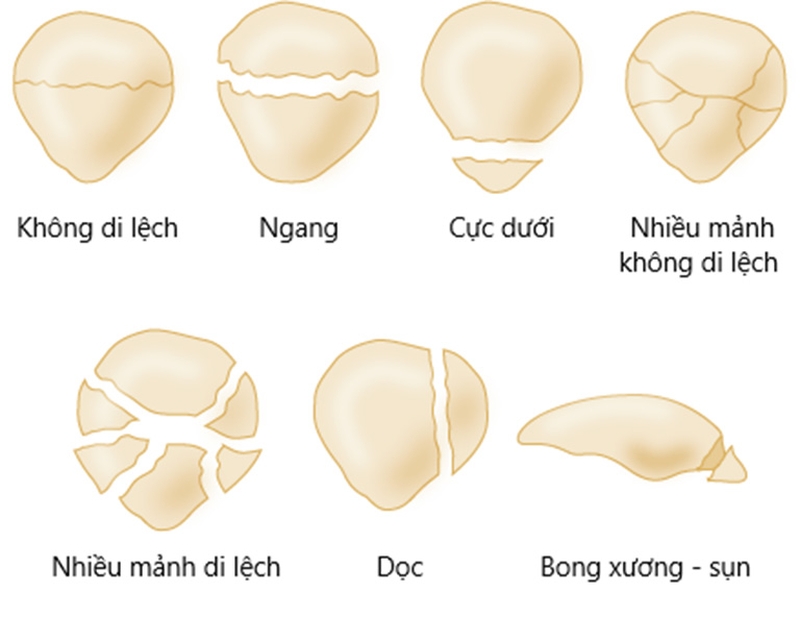 Giải đáp: Gãy xương bánh chè có đi lại được không? 2