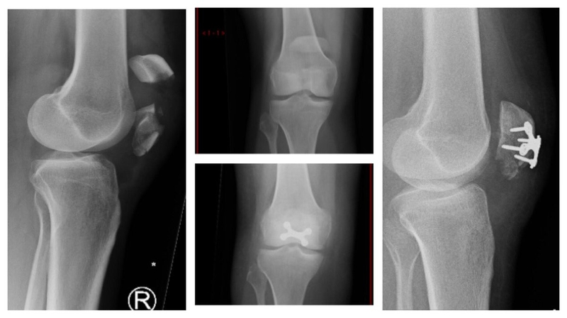 Giải đáp: Gãy xương bánh chè có phải mổ không? 2