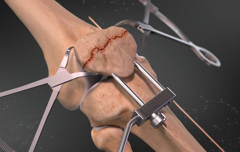 Giải đáp: Gãy xương bánh chè có phải mổ không? 4