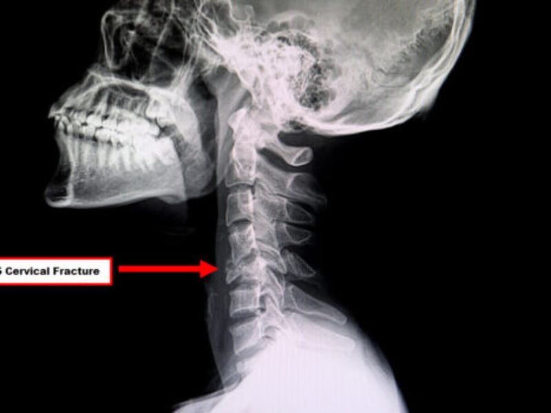 Tổng quan về tình trạng gãy xương cổ 4