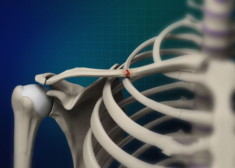 Gãy xương đòn 2 tháng có liền được không 1