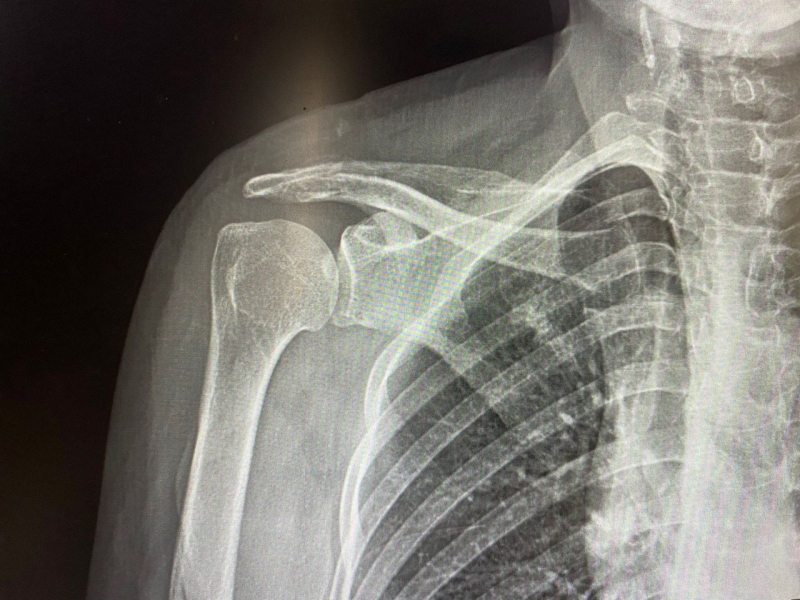 Gãy xương đòn bao lâu đi xe máy được 1