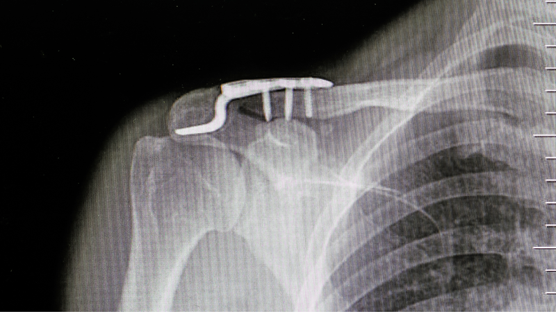 Gãy xương đòn bao lâu thì tháo nẹp? 3