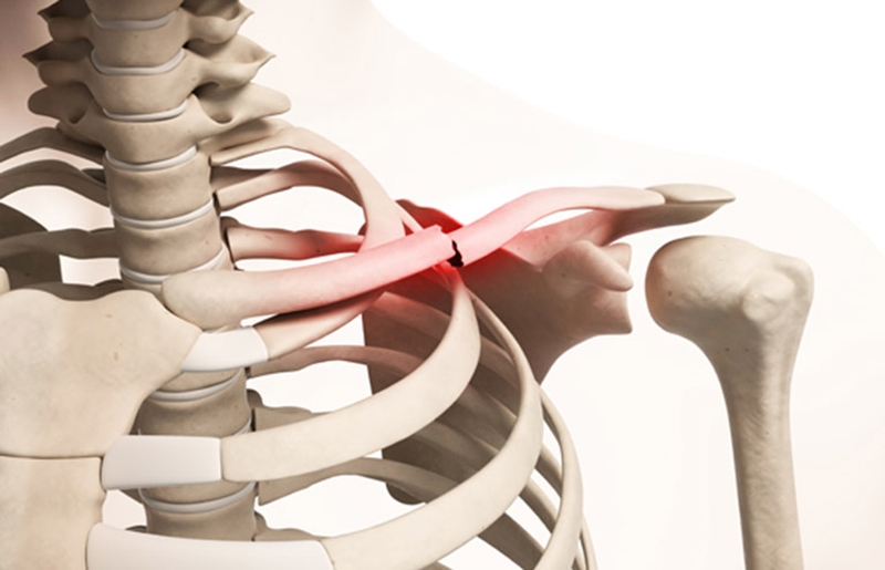 Gãy xương đòn có tập gym được không 1