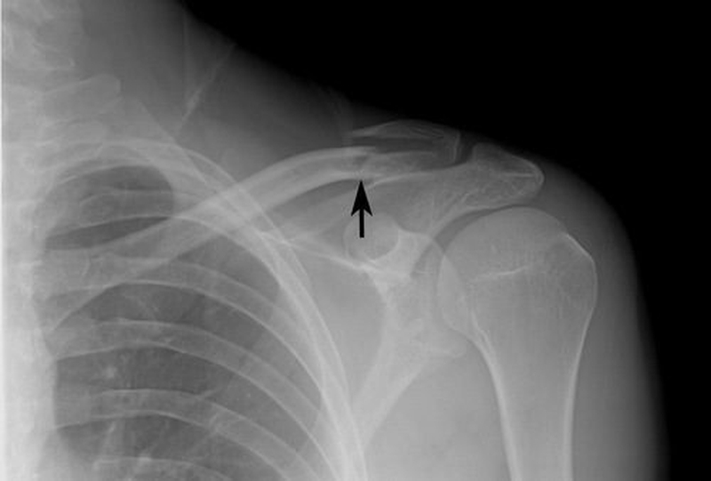 Gãy xương đòn nên ăn gì để mau hồi phục 1