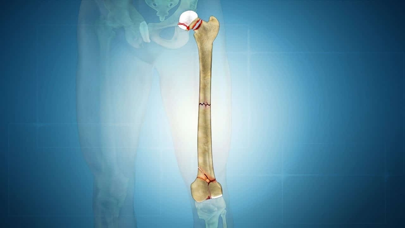 Gãy xương đùi bao lâu thì lành Lưu ý khi điều trị gãy xương đùi 1