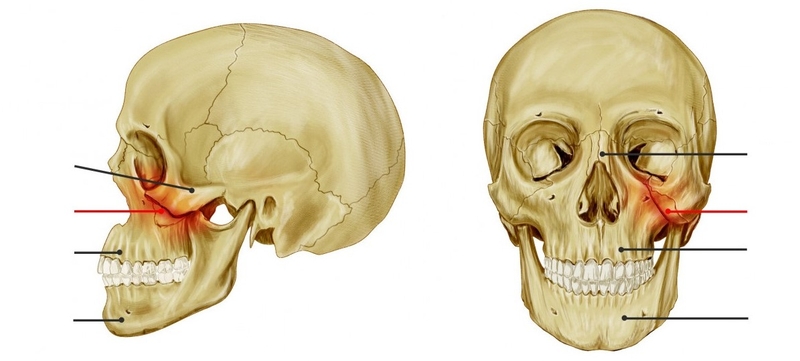 Vài nét về tình trạng gãy xương gò má 1
