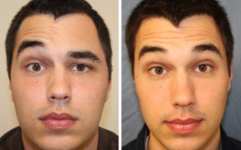 Vài nét về tình trạng gãy xương gò má 5