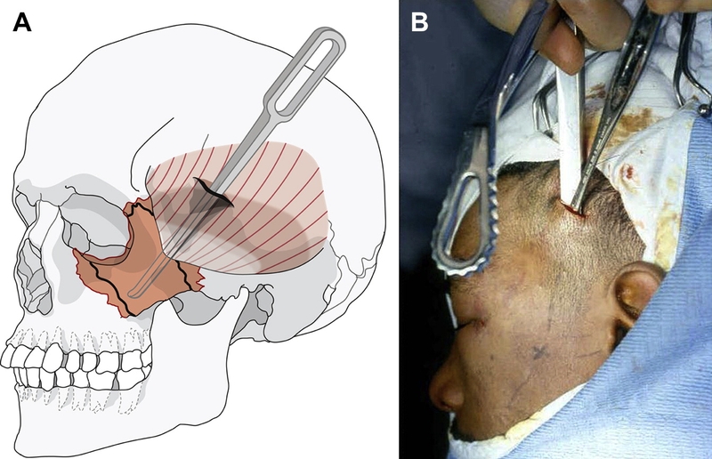 Giải đáp: gãy xương gò má bao lâu lành ? 4