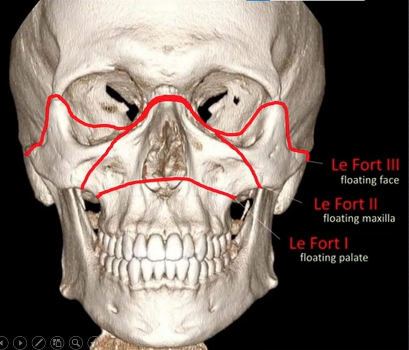 Giải đáp thắc mắc: Gãy xương gò má có cần phẫu thuật không? 1