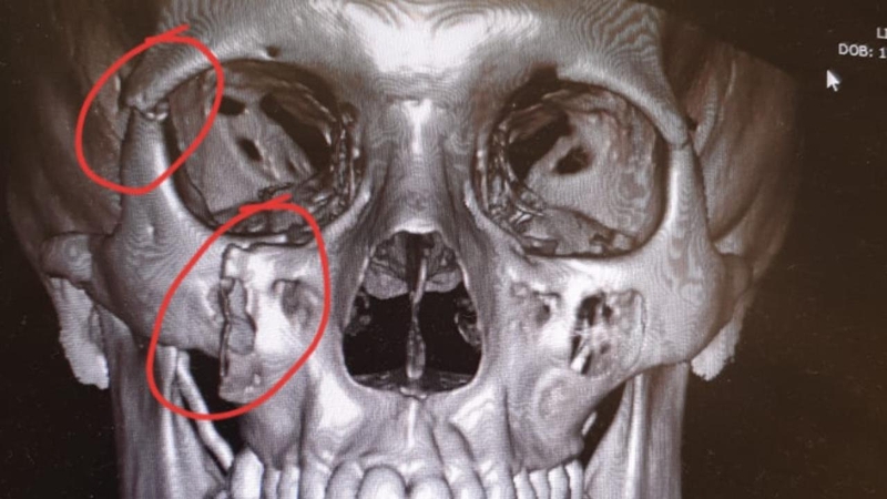 Giải đáp thắc mắc: Gãy xương gò má có cần phẫu thuật không? 4