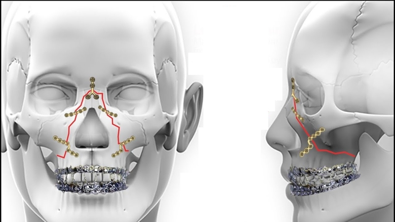 Giải đáp thắc mắc: Gãy xương gò má có cần phẫu thuật không? 5